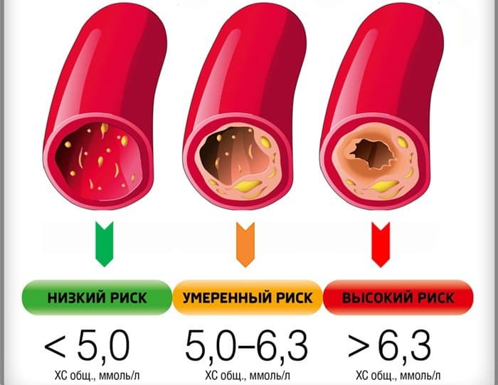 Уровень холестерина и развитие атеросклероза сосудов.
