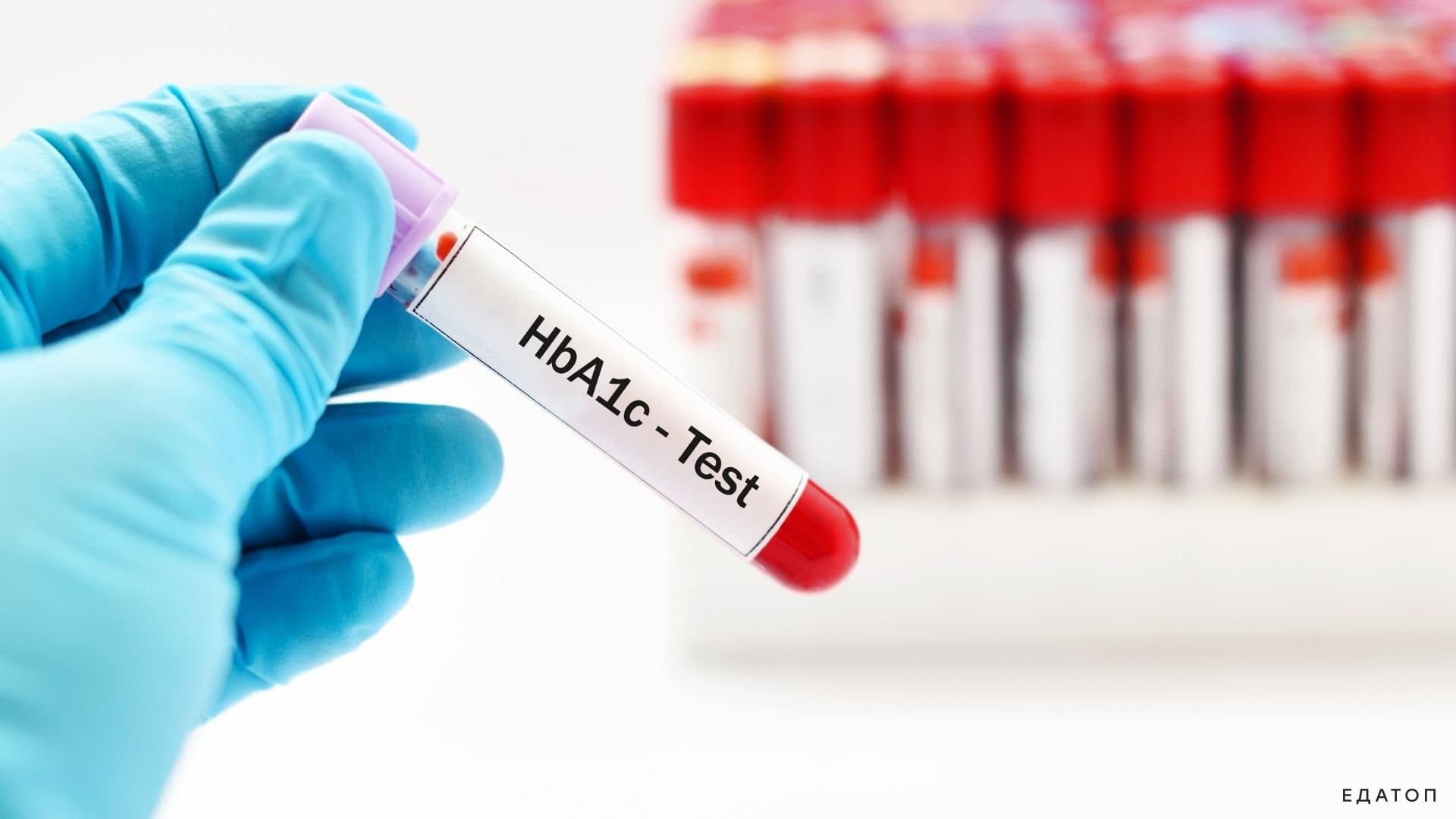 Анализ HbA1C позволяет оценить концентрацию глюкозы.
