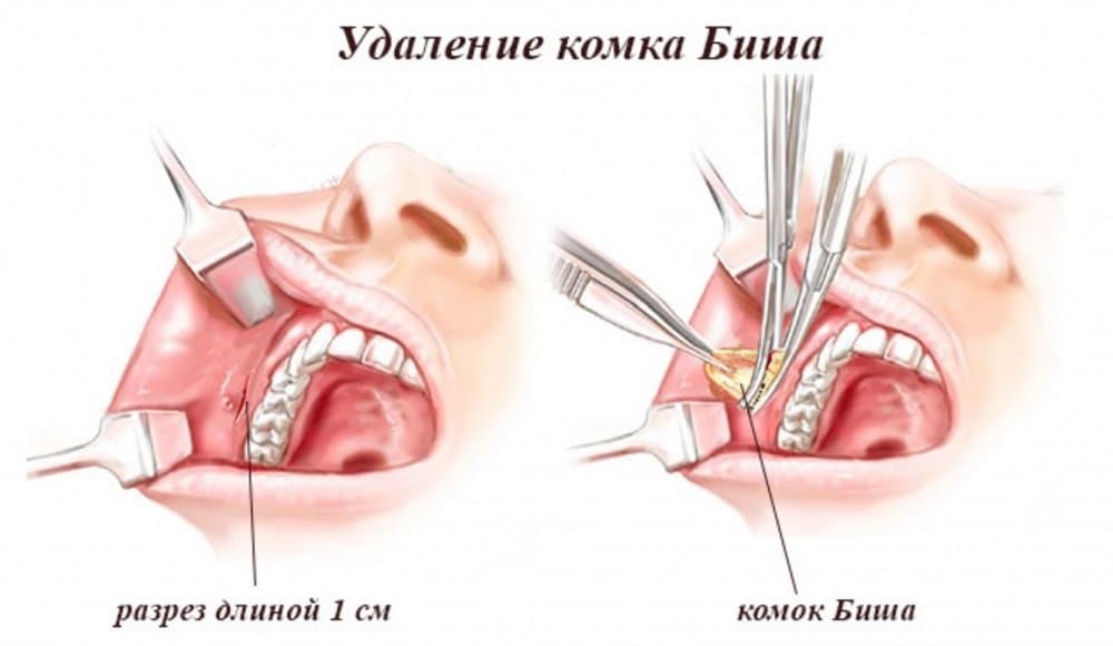 Процедура удаления комков Биша.