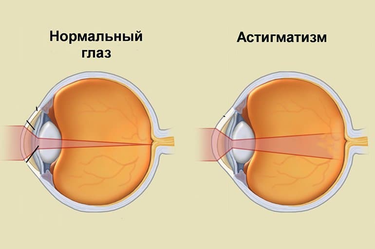 Астигматизм - заболевание, которое характеризуется неправильной формой роговицы.