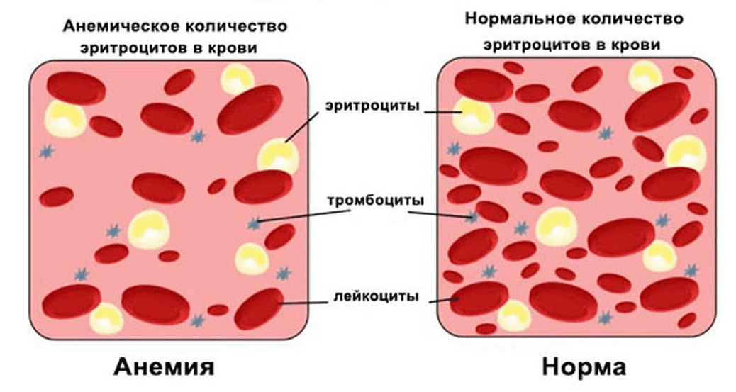 Яйца обязательно нужно употреблять при железодефицитной анемии.