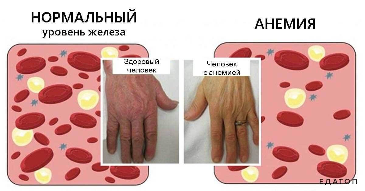 Дефицитная пернициозная анемия может возникать из-за нехватки витамин В12.
